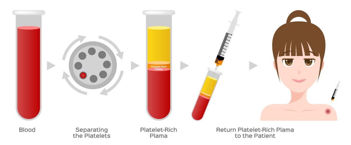 Chin Up! Aesthetics - Platelet Rich Plasma (PRP) Injections